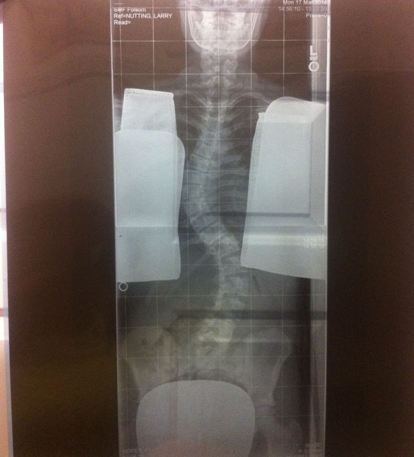 Herrman spine photo